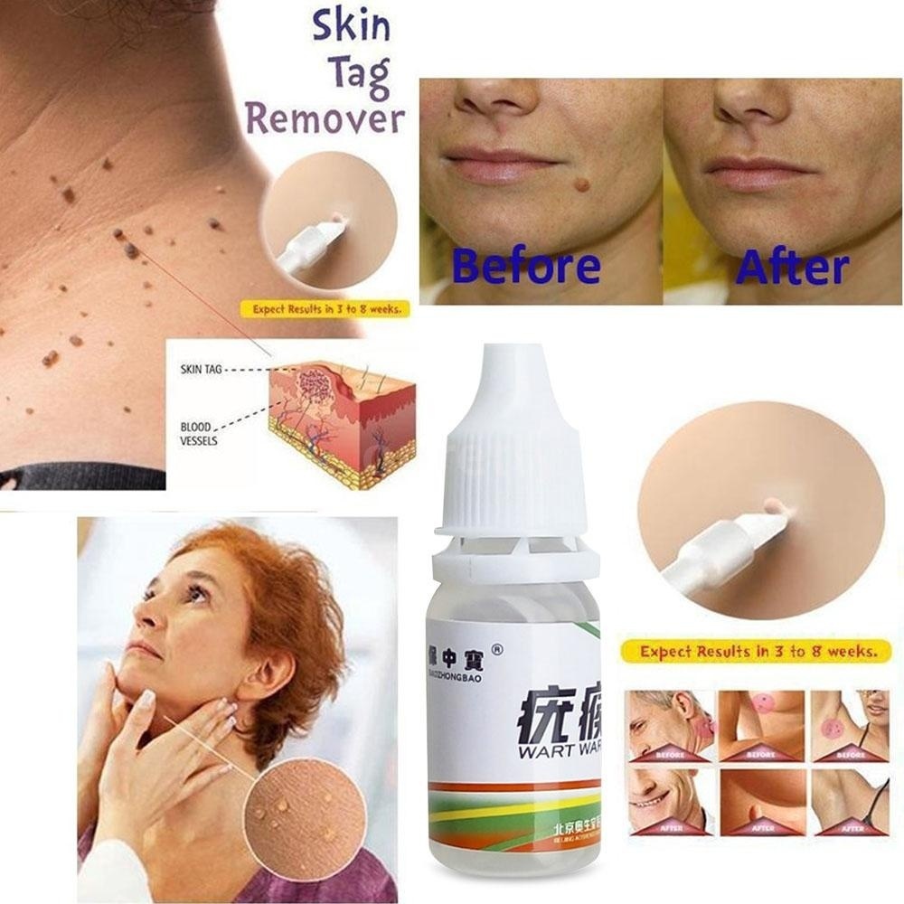 Skin Tag Remover Medical Tu Kill Remover Warts Treatment Foot Corn