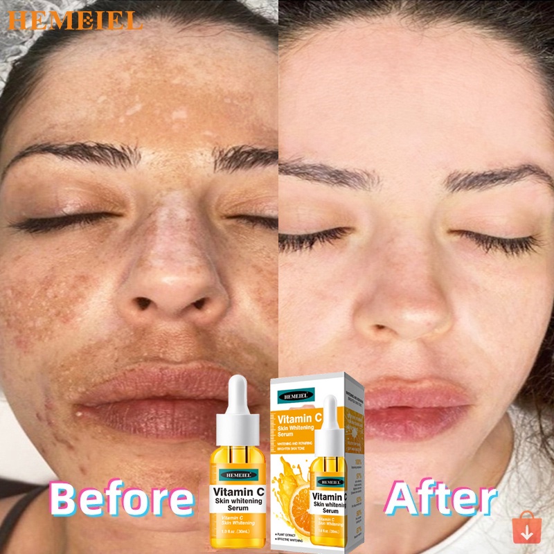 HEMEIEL Vitamin C c/Vitamin E Serum For Face/ Melasma Soap /Serum For
