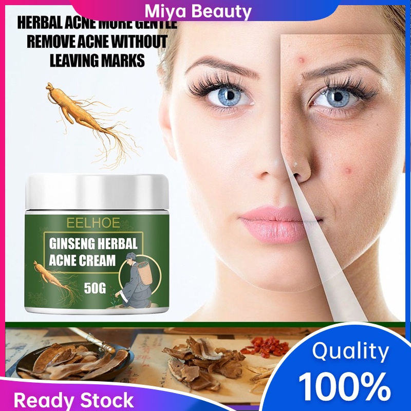 Readystock Acne Cream Anti Acne Cream Acne remover pimple remover acne