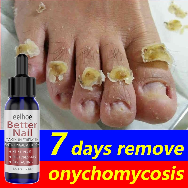 Eelhoe Nail repair treatment cream 50ml Nail treatment fungal Nail