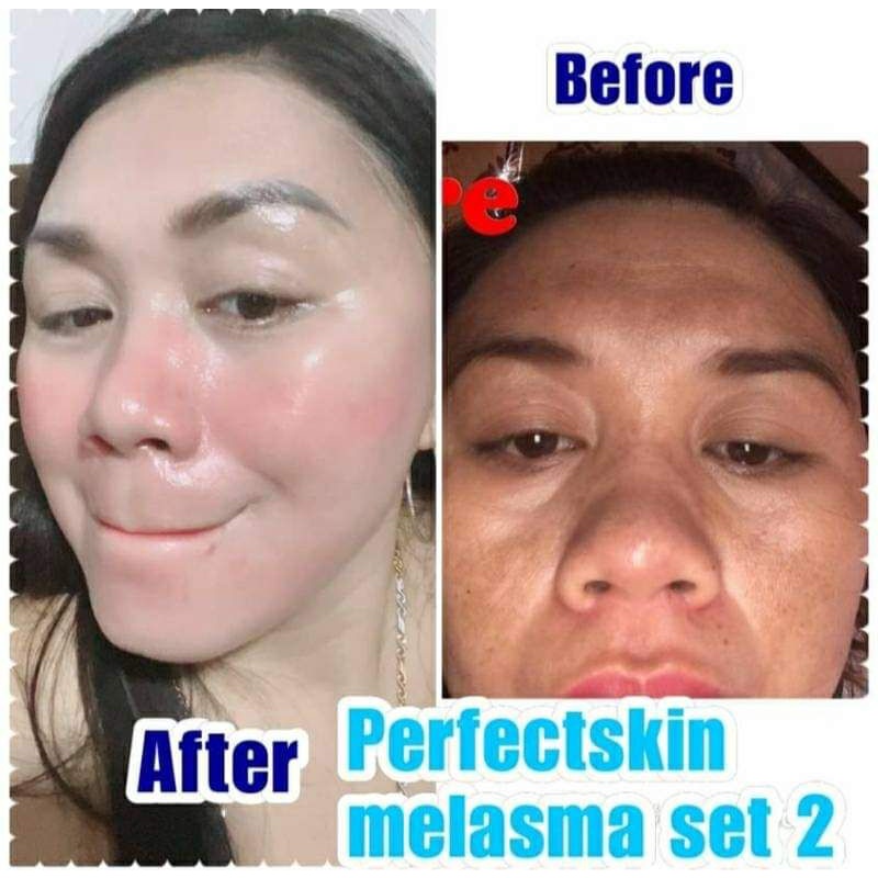 Perfect Skin Melasma /Pekas Set | Shopee Philippines