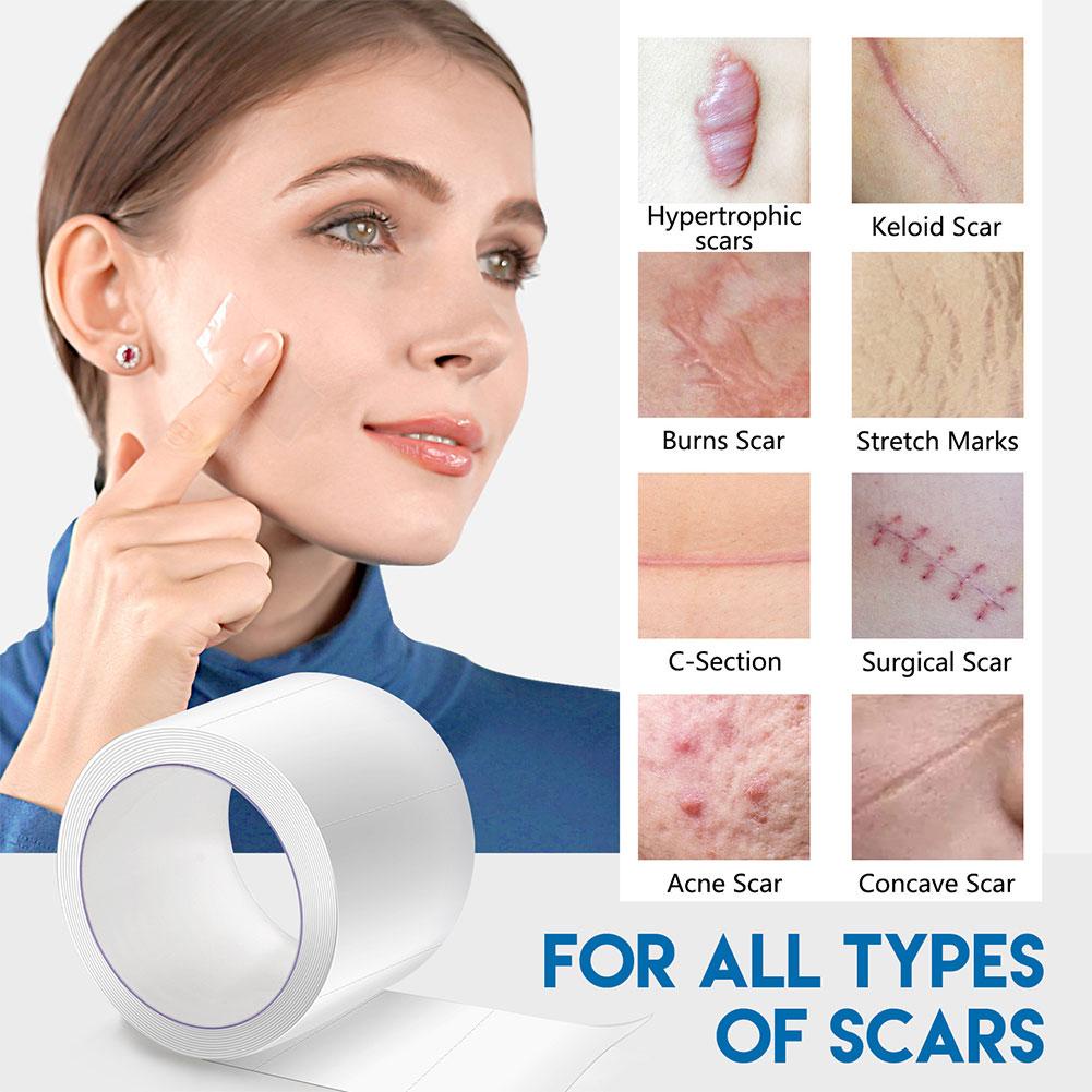 2.5cm * 1.5m Face Invisible Scar Roll Sticker Self-adhesive Silicone ...