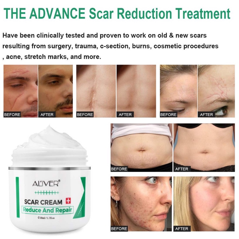 Acne Scar Remover Old Scar Scarminator Cream Strech Mark Remover Scar