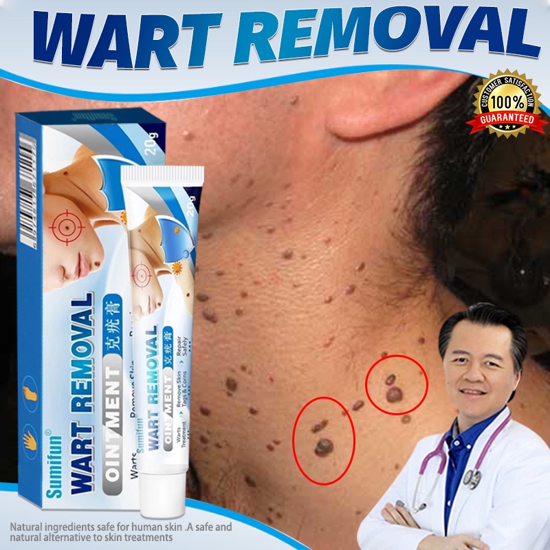 Warts Remover Original Kasoy Oil Cream Mole Skin Tag Wart Remover Genital Removal Original