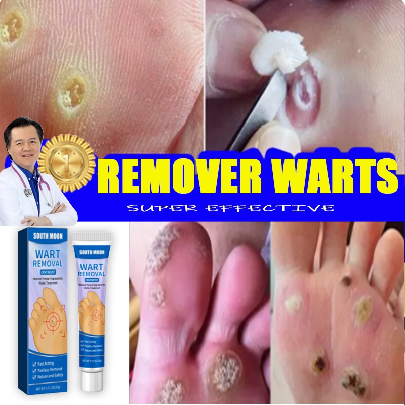 Warts Remover Original Kasoy Oil Cream Mole Skin Tag Wart Remover Genital Removal Original