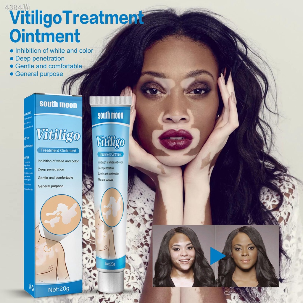Skin Fighter Herbal Extract Vitiligo Ointment Remove Ringworm White
