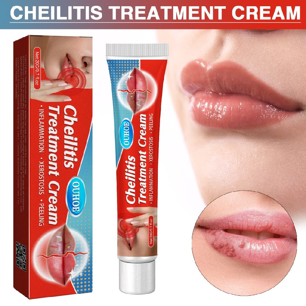 20g Cheilitis Treatment Cream for Dry Chapped Cracked Peeling and