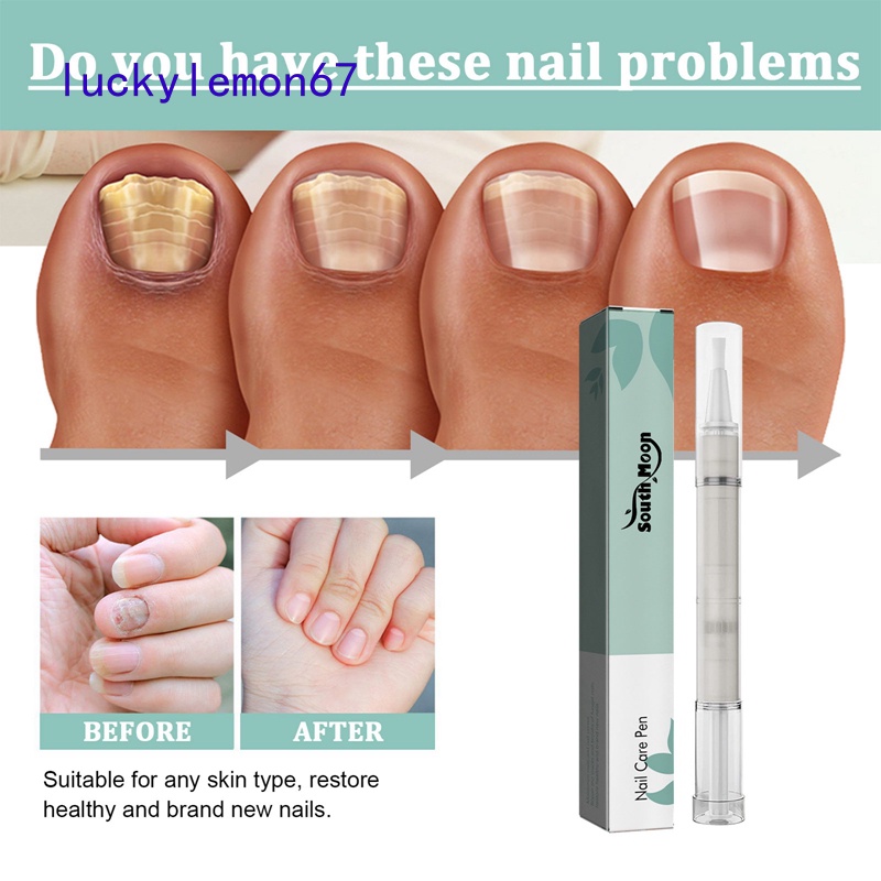 Nail repair pen, onychomycosis care solution, clean bright nail