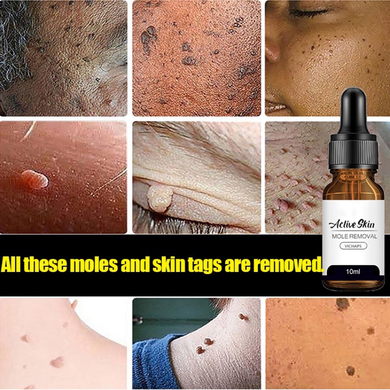 Spots and moles removal essence/Skin Tag remover Against Mole & Genital