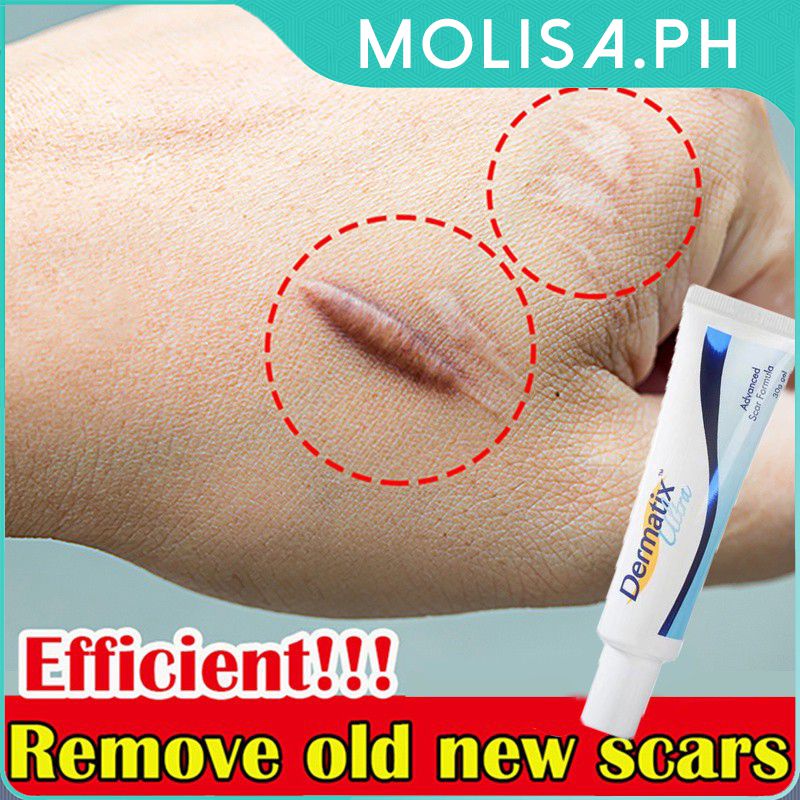 Dermatix Advance Scar Dermatix Ultra Scar Gel Scar Remover Cream Ubat Parut Luka Scar Cream Scar