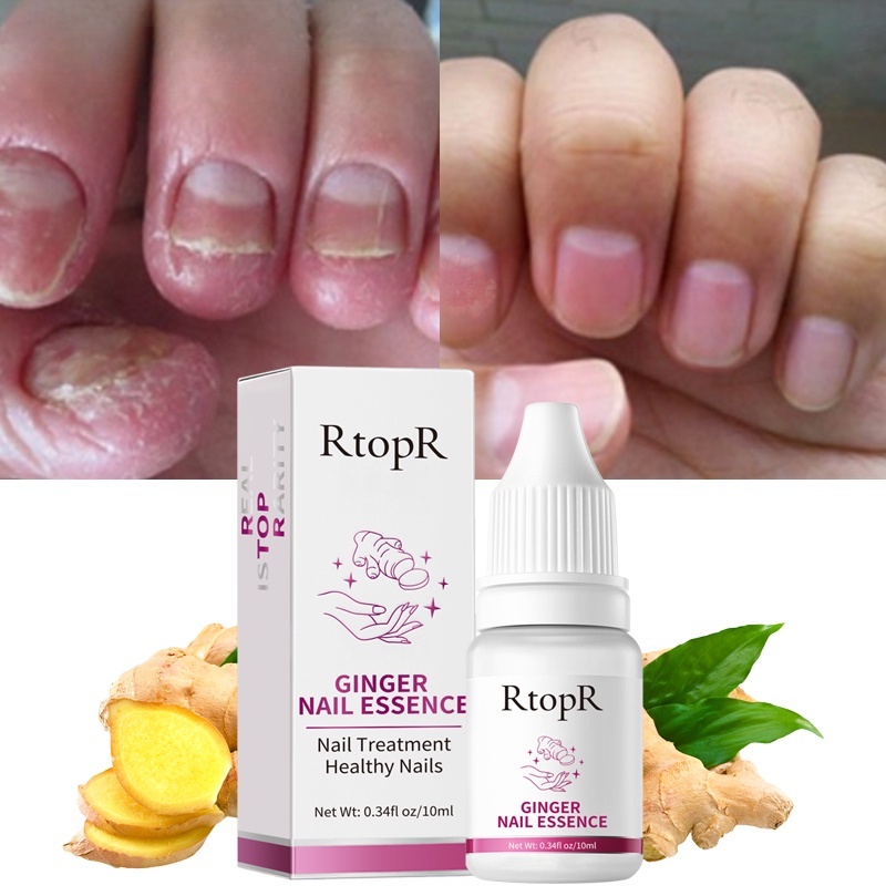 Ginger Antibacterial Nail Treatment Essential Anti Fungal Infection Toe ...