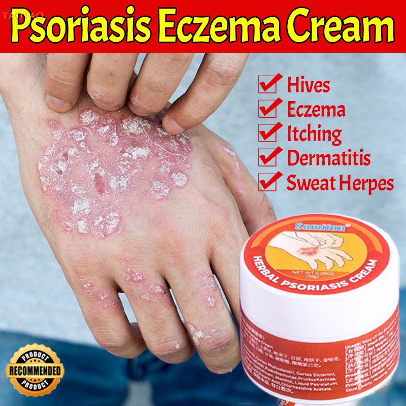 Sumifun Eczema Cream Psoriasis Ointment Antibacterial Cream Itching Sweat Herpe Dermatitis