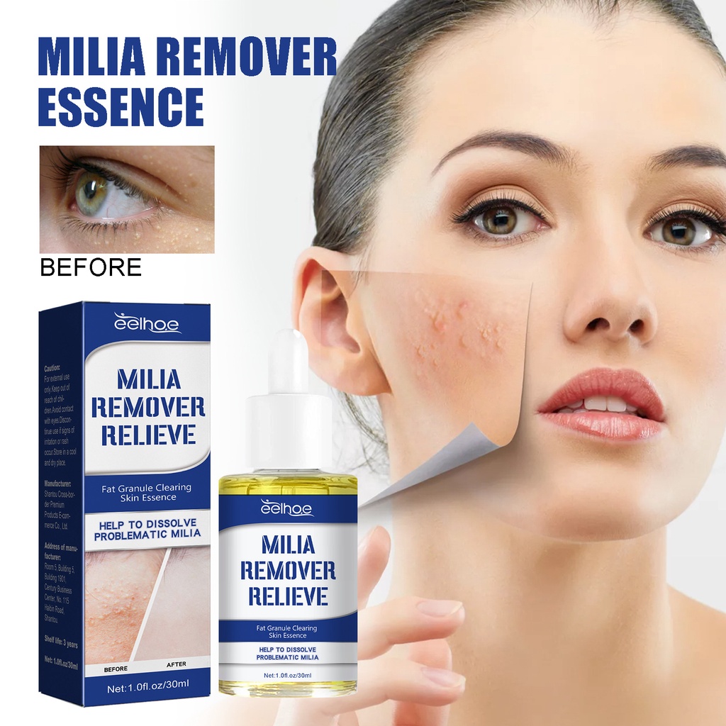30ml Milia Remover oil Milia Spot Treatment for Eye, Milia Treatment