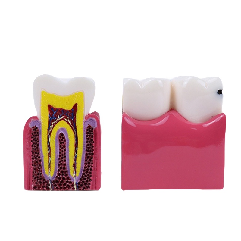 Dental Study Model 6 Times Caries Study Models For Dentist Studying and ...