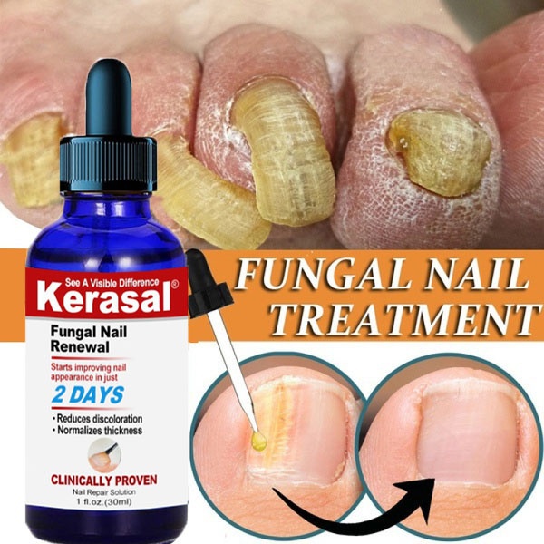 Super Nail fungus Treatment, The Best Nail Repair, Avot Fungal Growth