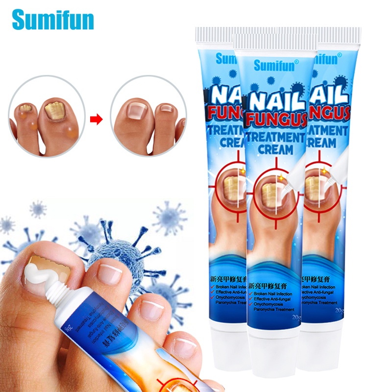 Sumifun 20g Nail Fungus Treatment Cream Paronychia Onychomycosis