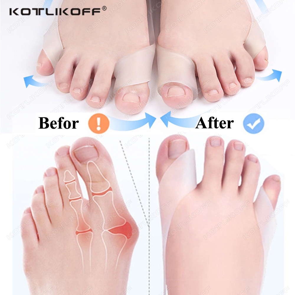 Silicone Toe Corrector Hallux Valgus Bunion Toe Overlappin Orthotics ...