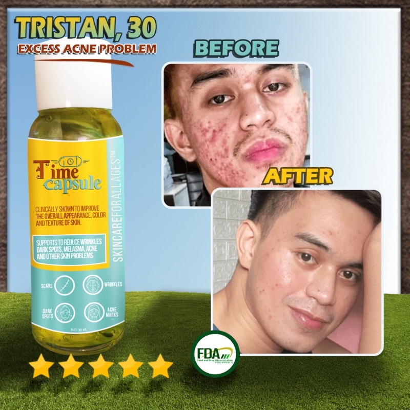 Authentic Time Capsule By Dra. Vicky Belo,a New for Scars Old Scar 10ml