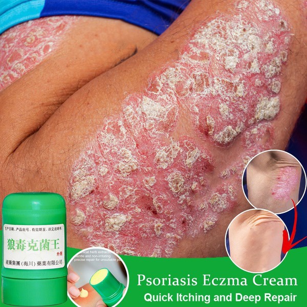 Skin Psoriasis Eczma Cream for All Kinds of Skin Problems Chinese ...