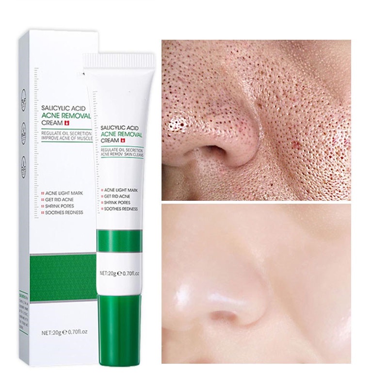 Salicylic Acid Acne Remove Acid Acne Cream 20g Blackhead Removal Anti Acne Scar Pimple Eraser