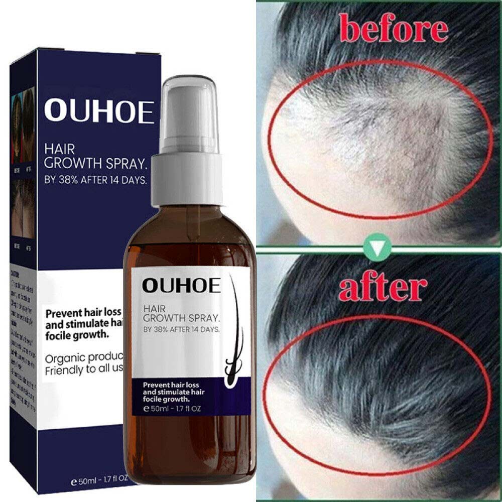 OUHOE hair growth spray strengthens hair roots to prevent hair loss
