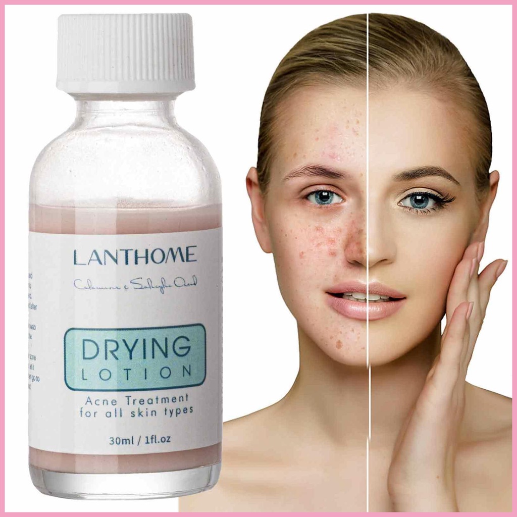Calamine Drying Lotion Overnight Spot Treat for Face and Body Blemish