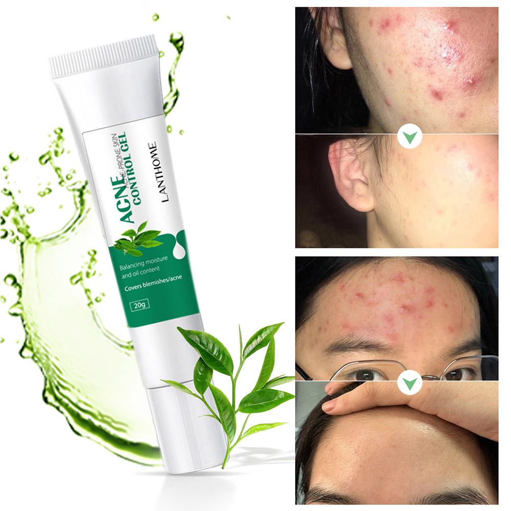 Salicylic Acid Acne Cream Face Care Ointment Remove Acne Eliminate Acne Mark Pore Contraction