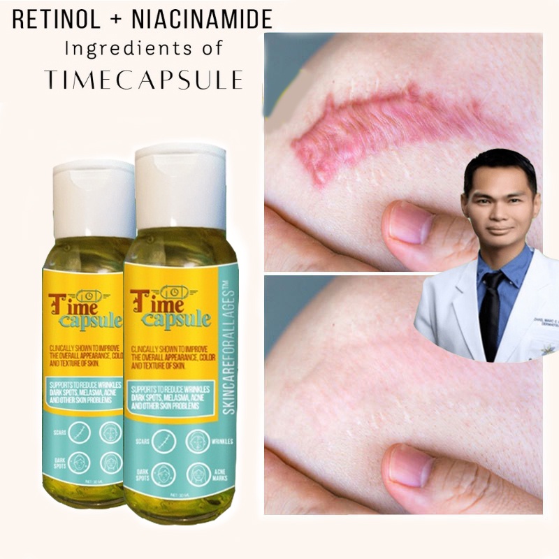 Time Capsule for Scars Old Scars Keloids Acne Melasma Stretch Mark