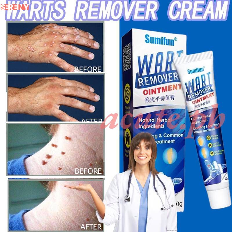 Effective Warts Remover Cream Warts Removal Foot Corns Kulugo Skin Tags