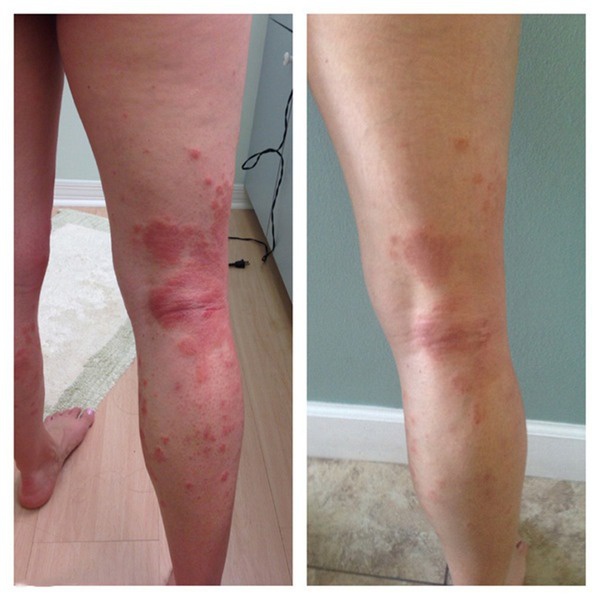 Skin Psoriasis Eczma Cream for All Kinds of Skin Problems Chinese ...