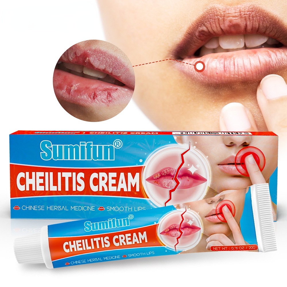 20g Cheilitis Treatment Cream Inflammation Labial Herpes Antibacterial