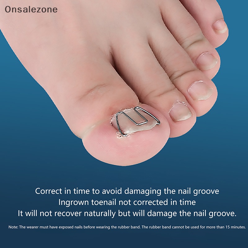 ONPH 3 Pairs Front Nail Hook/rubber Band Nail Art Ingrown Toe Nail