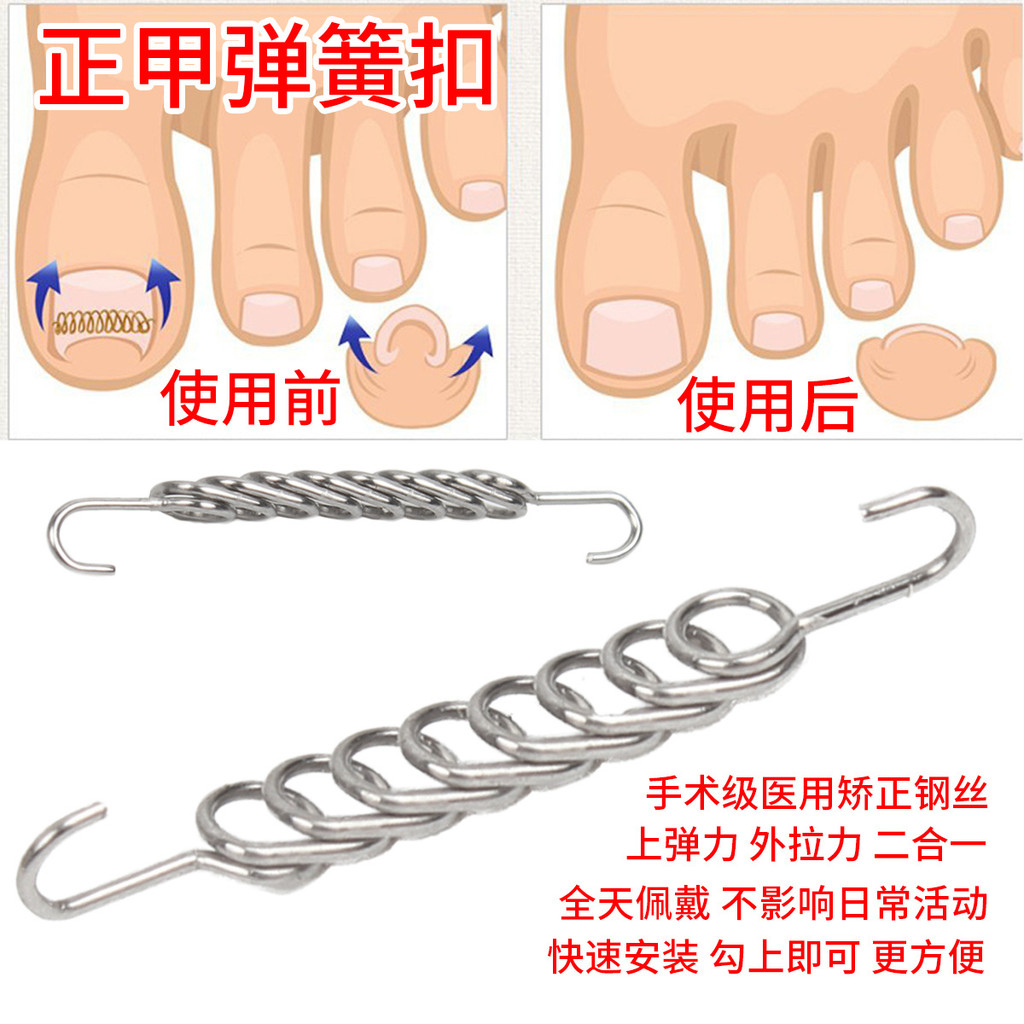 Japanese Technology Ingrown Toenail Correction Wire Spring Correction ...