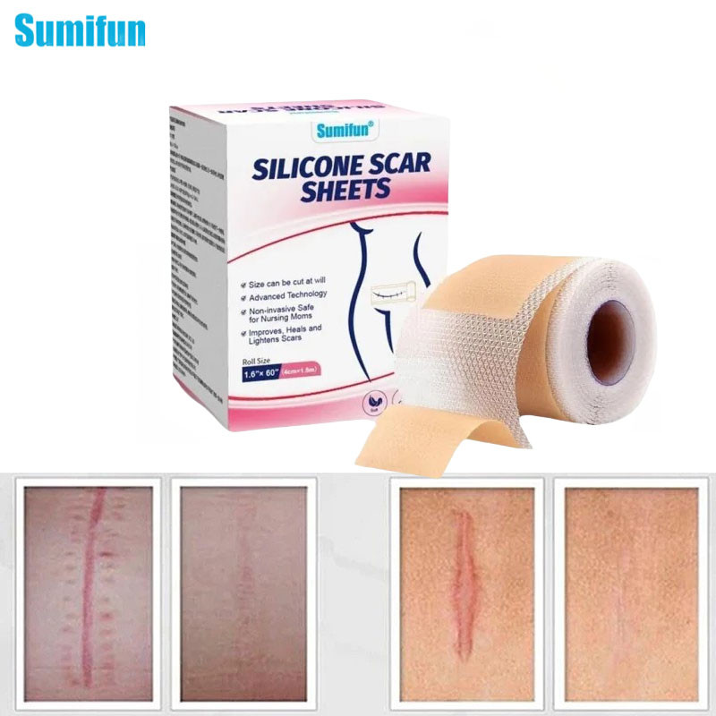4*150cm 【Silicone Scar Patch 】Surgery Scar Removal Silicone Gel Sheet ...