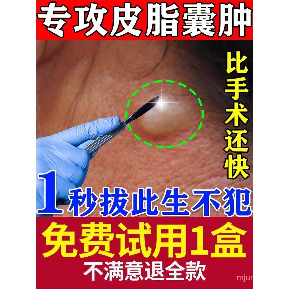 Sebaceous Cyst Cream for Removing Powder Cysts, Subcutaneous Cysts ...