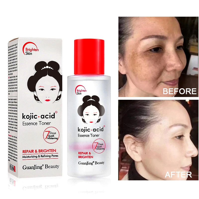 Kojic Acid Face Toner 100ml – Strong Brightening, Whitening, Dark Spot ...
