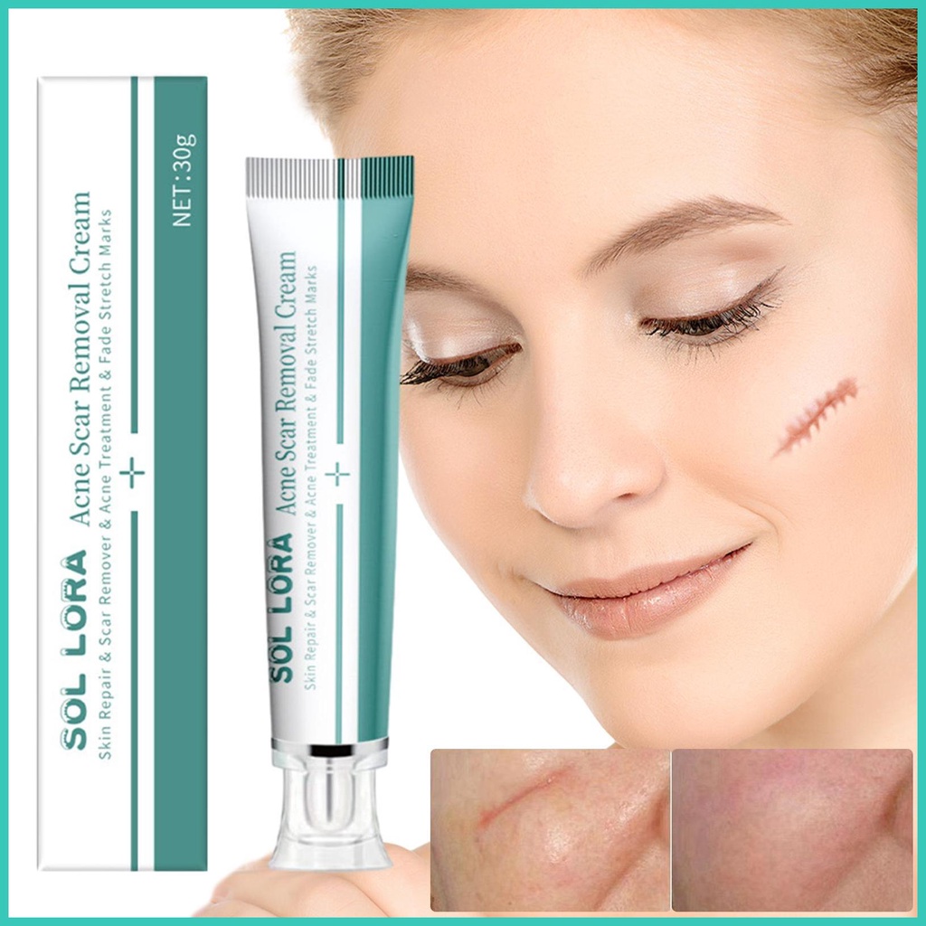 Advanced Scar Cream Stretch Marks Removal Cream 30g Effective Old And