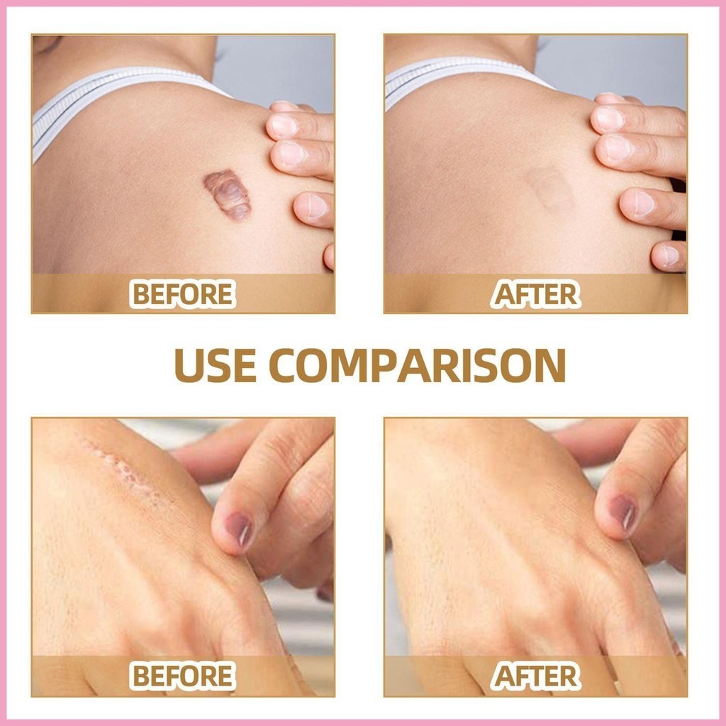 Scar Cover Stickers Skin Covering Tape for Concealing Scars Waterproof ...