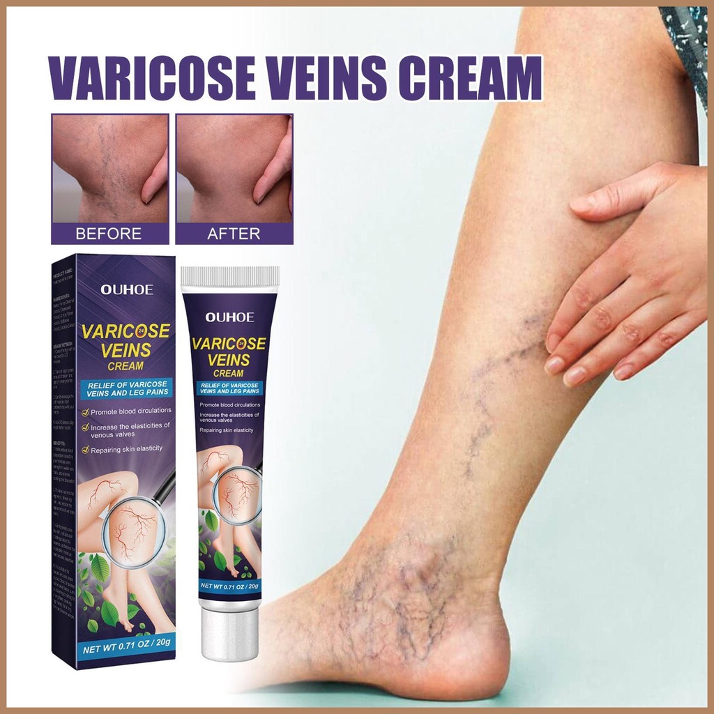 Vasculitis Phlebitis Spider Hurt Relief Cream Natural Varicose & Spider ...