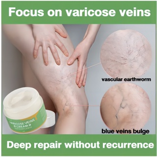 Advanced Clinicals Varicose Veins Treatment For Legs | Spider Vein &  Varicose Vein Cream | Collagen Cream | Vitamin K Cream | Arnica Cream 