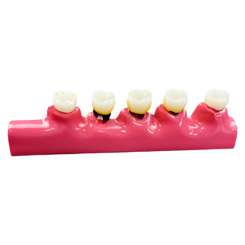 Dental Model Caries Classify Pathological Model Tooth Caries Evolution ...