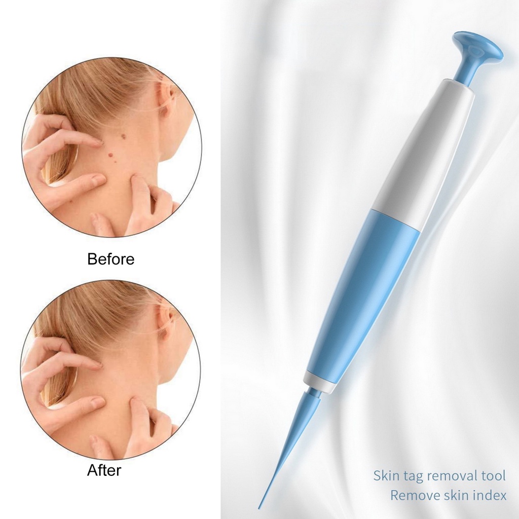 GA Easy to Use Skin Tag Removal Kit Fast Wart Removal Easy and Safe