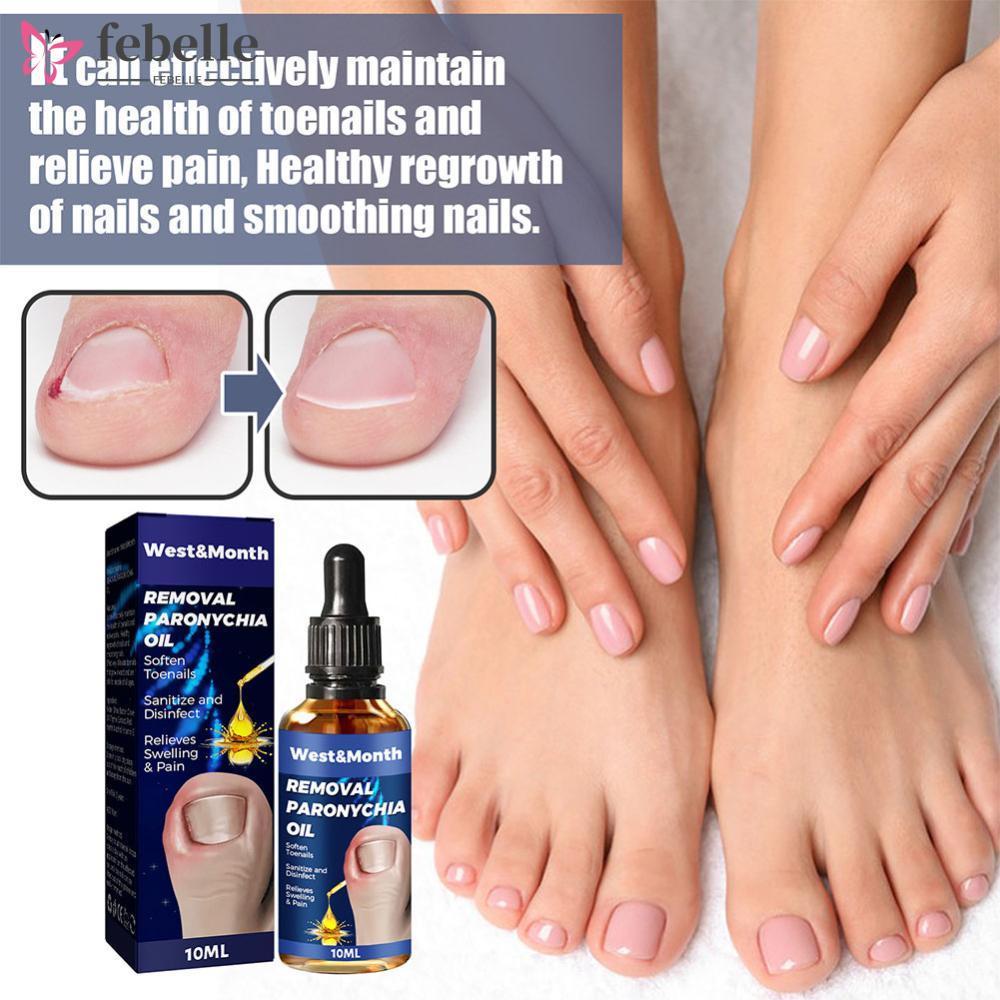 FEBELLE 10ml Removal Paronychia Oil Soften Toenails Relieve Swelling ...