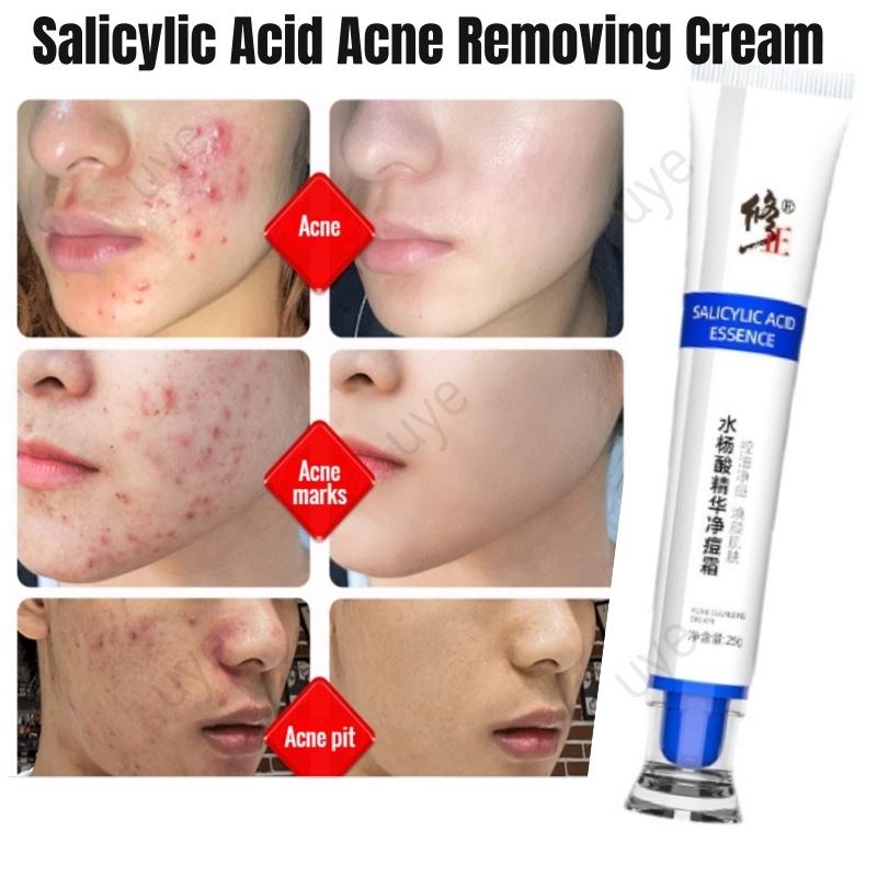 Salicylic Acid Acne Removing Cream Mild repair of acne scars and pits