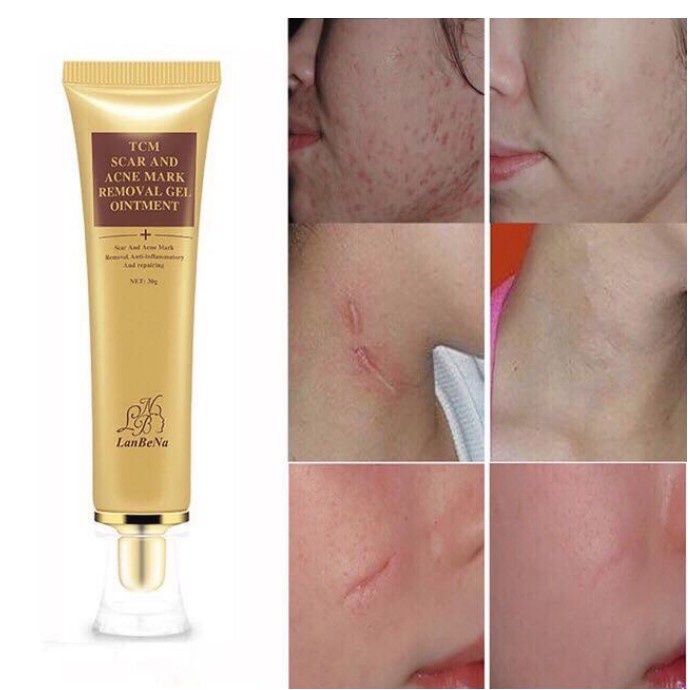 ♟Lanbena TCM scar and acne mark removal Remover gel ointment 30g