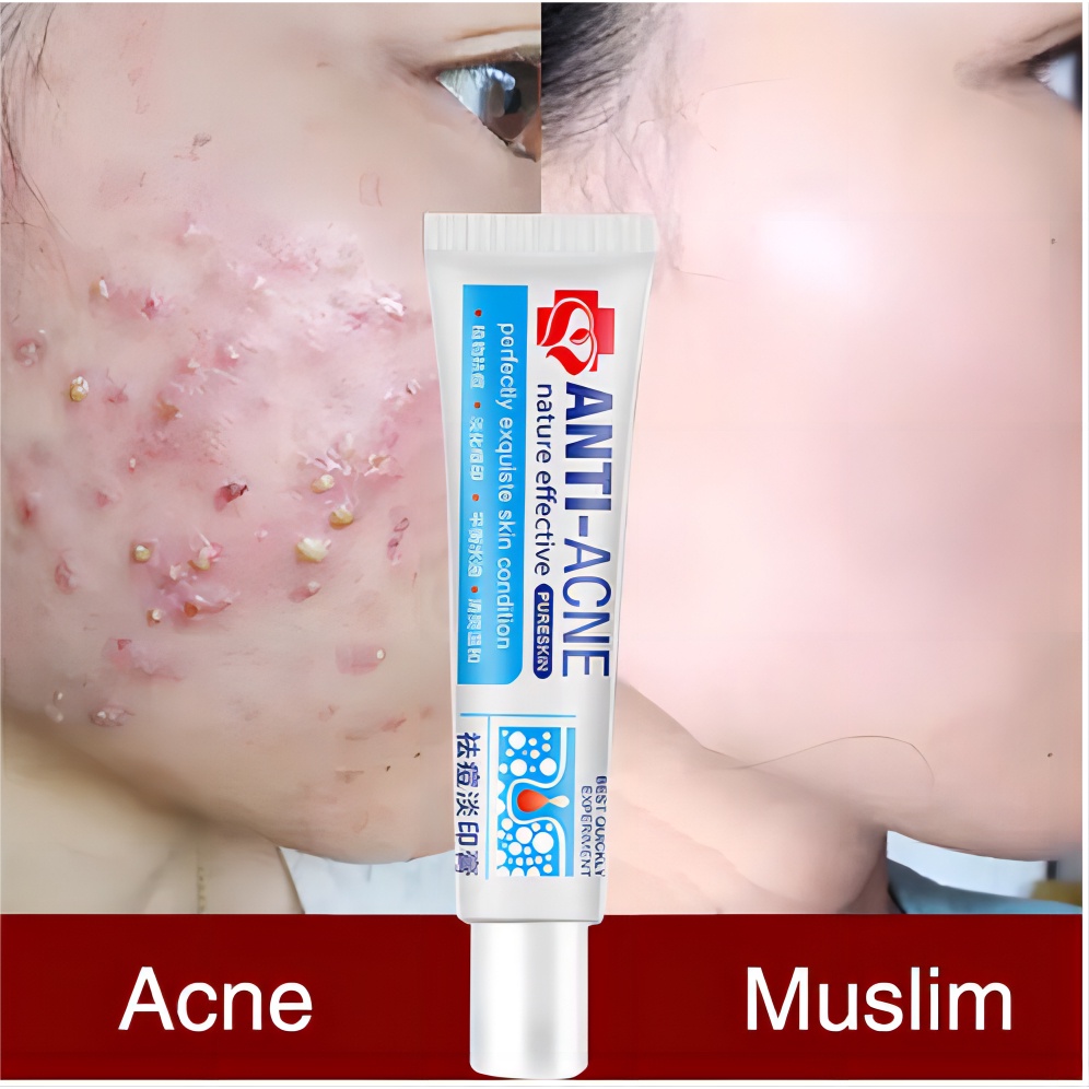 100 effective Scar Removal Cream 30g AntiAcne Cream Acne Treatment Gel Pimple Scars Remover