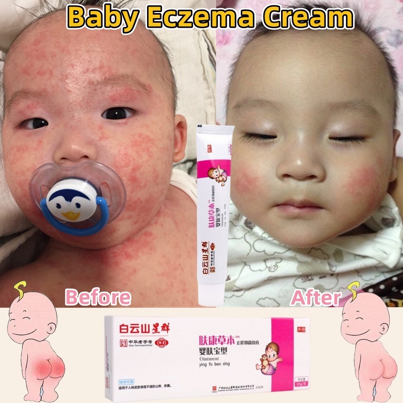 Eczema Cream baby krim gatal Removal prickly heat Eczema Treatment