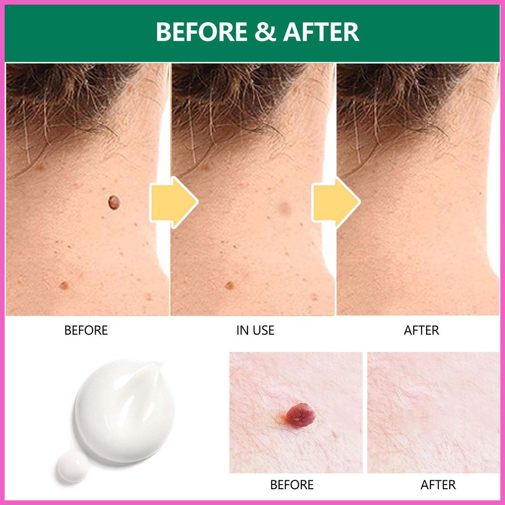 Acnes Warts Ointment 20g Wart Cureness Cream Warts Remover Cream Wart