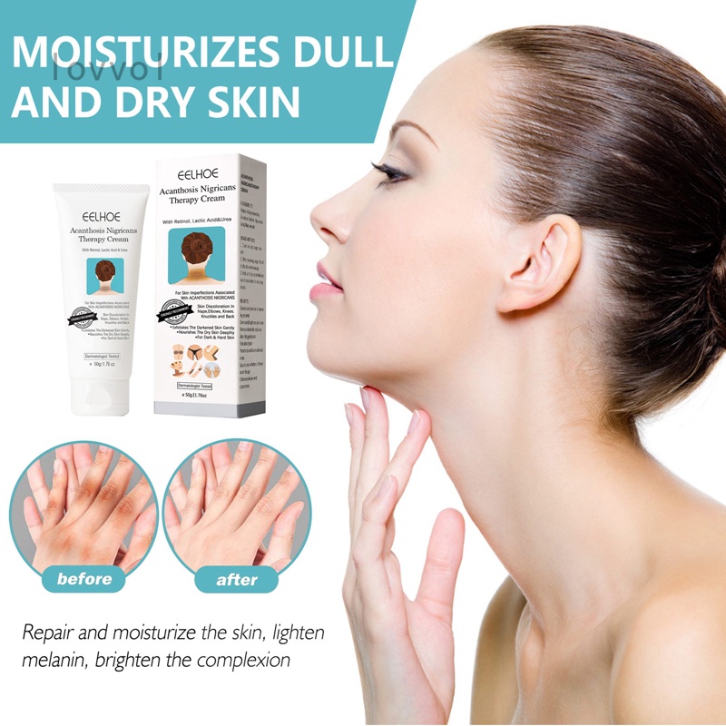 Acanthosis Nigricans therapy cream,Removal Of Hyperpigmentation