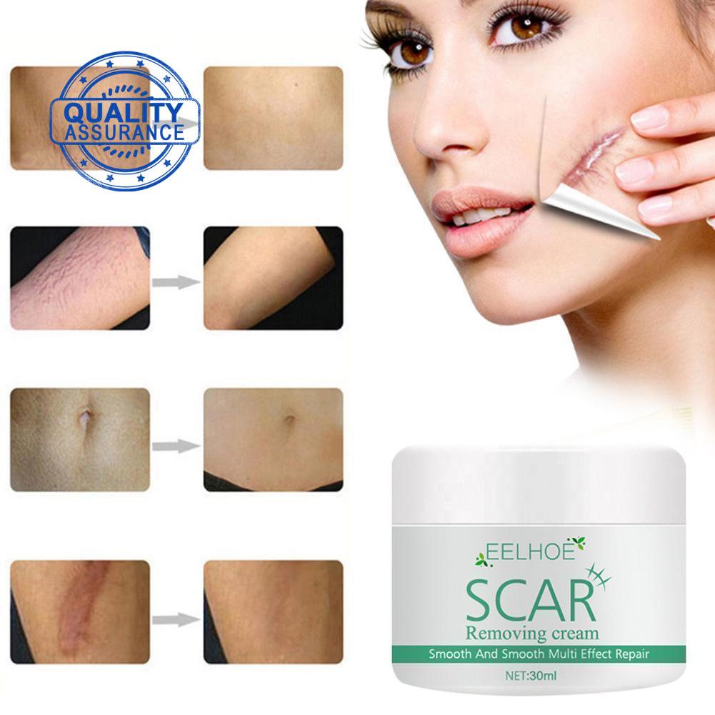 EELHOE Scar Removal Cream For Old Scars Stretch Mark Spots Gel B6V8